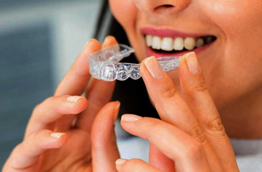 Šta je Invisalign: Saznajte sve o folijama za ispravljanje zuba