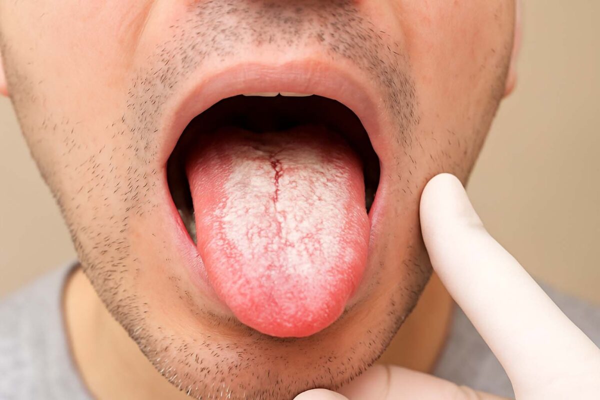 Read more about the article Kandida na jeziku: Uzroci, simptomi i lečenje oralne kandidijaze