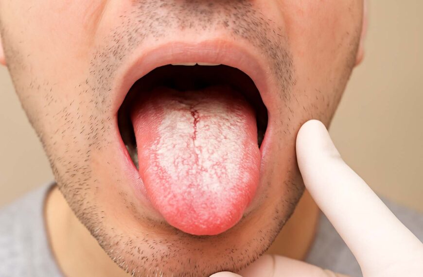 Kandida na jeziku: Uzroci, simptomi i lečenje oralne kandidijaze